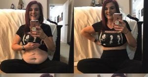 How to deal with Loose Skin After Weight Loss